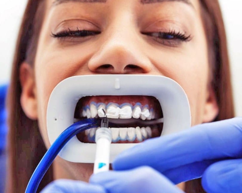 Diş Beyazlatma Bleaching Fiyatı